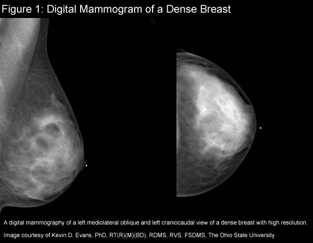 Ducts In Breast. lining the ducts of breast