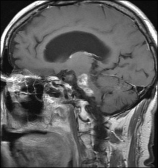 Causes Of Trigeminal Neuralgia Pdf Files